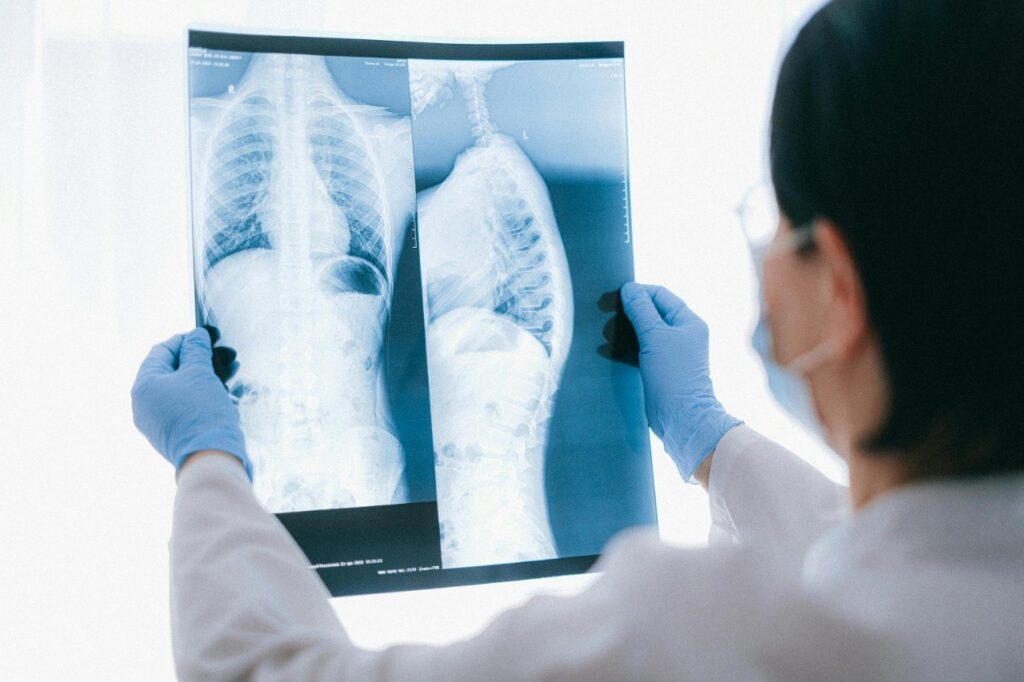 Tuberculose avança no Maranhão e especialistas alertam para “ameaça silenciosa”