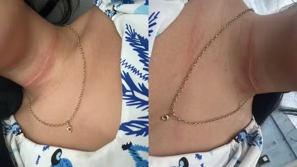 Adolescente fica ferida após ser atingida por linha de pipa no pescoço em Santa Inês