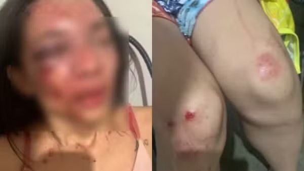 Mulher denuncia ter sido espancada com série de socos por companheiro no PI: 'corri pra rua pedindo ajuda'